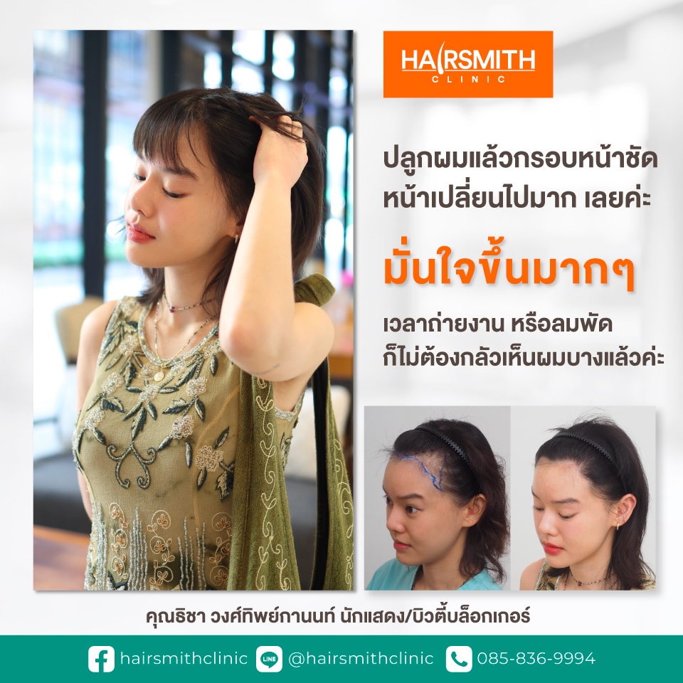 ปลูกผม ธิชา วงศ์ทิพย์กานนท์ ปลูกผม ธิชา วงศ์ทิพย์กานนท์