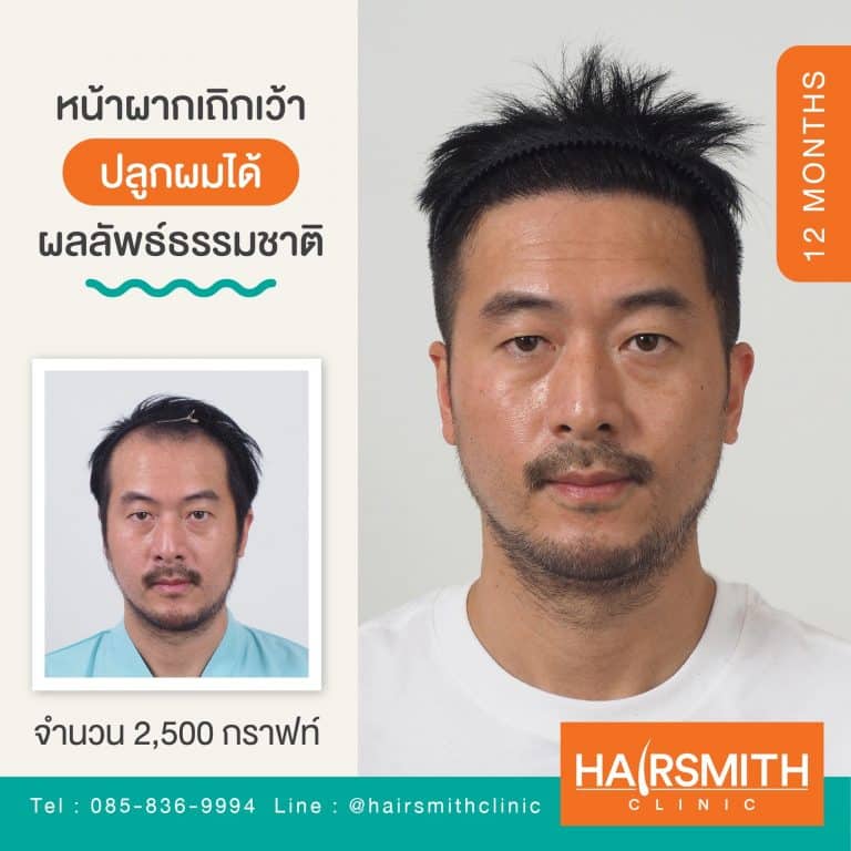 https://www.hairsmithclinic.com/does-hair-transplant-hurt