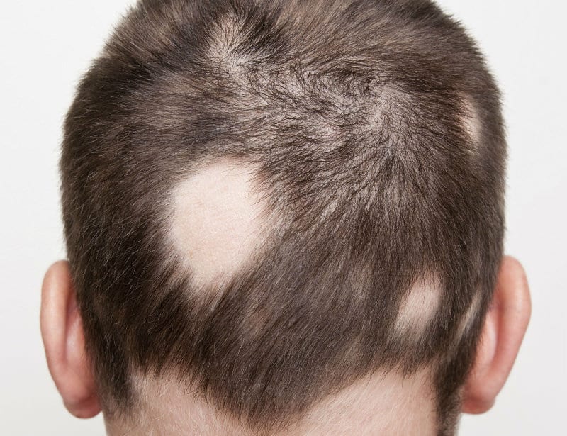 ALOPECIA AREATA_1