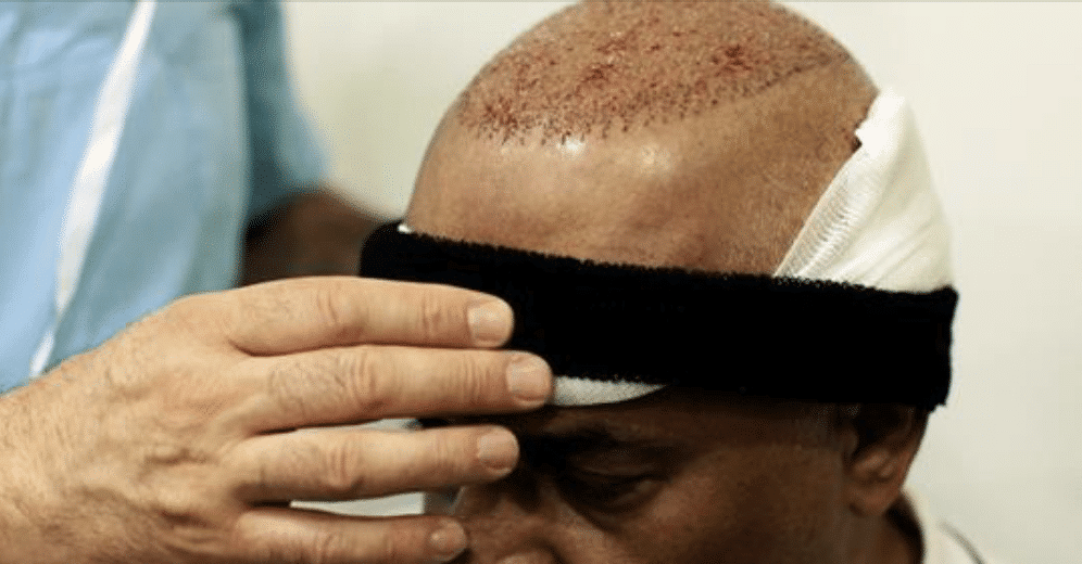 HAIR TRANSPLANTATION IN TURKEY_1