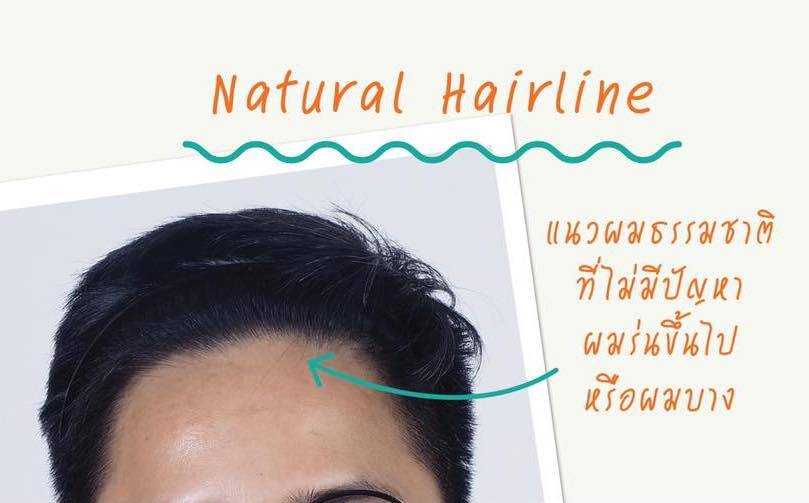 HOW TO CREATE A NATURAL LOOK FOR A HAIR TRANSPLANT_1