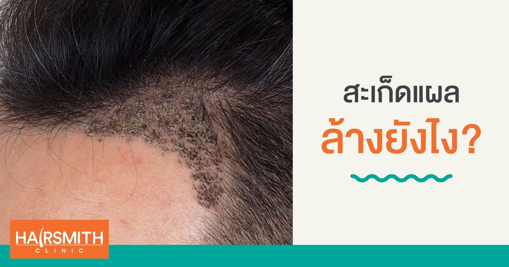 HOW TO WASH OFF SCABS AFTER HAIR TRANSPLANT_1