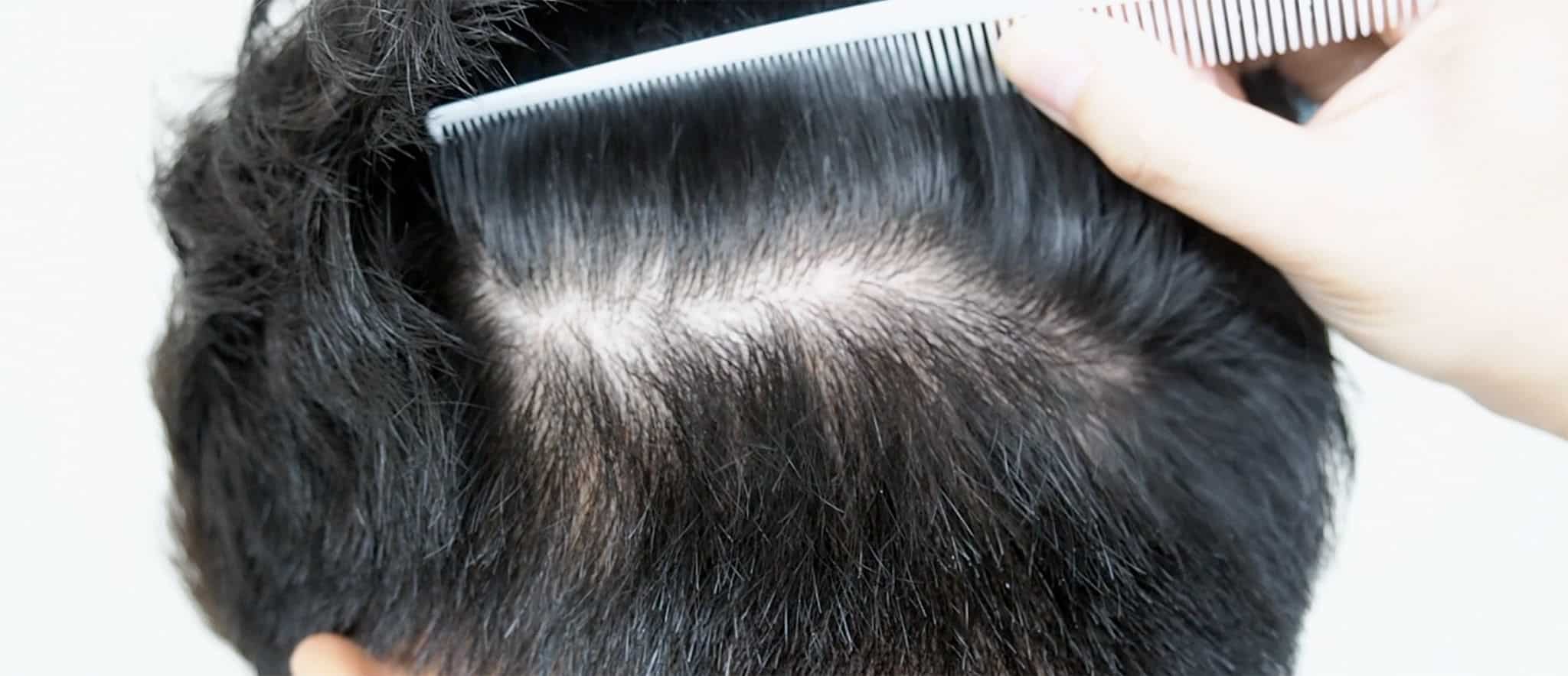 CARLESS HAIR TRANSPLANT SURGERY IS POSSIBLE? 1