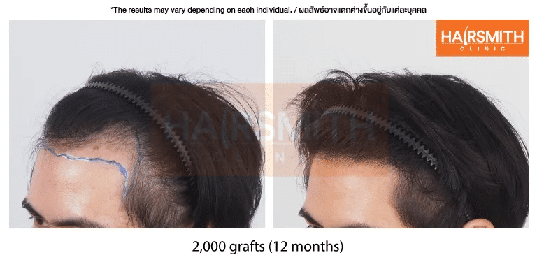 ปลูกผม FUE 2,000 กราฟต์ 12 เดือน - รีวิวจริงจากคลินิกปลูกผม Hairsmith Clinic