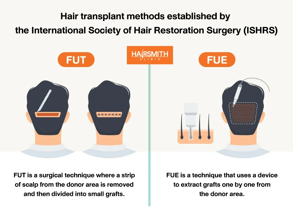 Types of Hair Transplantation