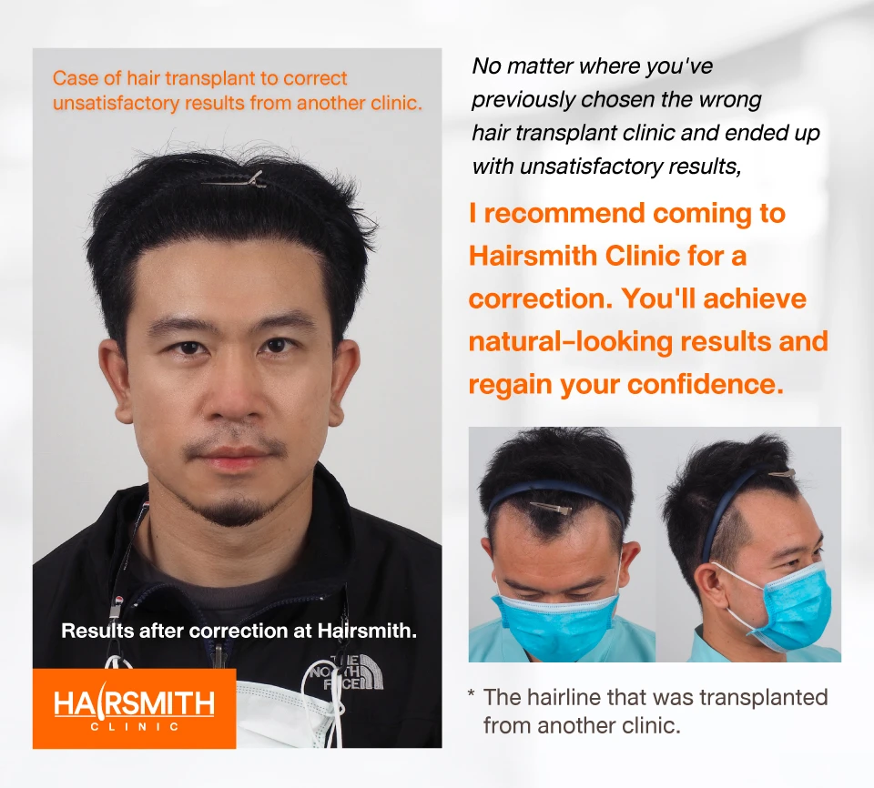 hair transplant review hair transplant review