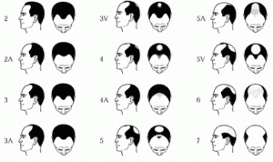 WHAT IS A REASON OF HAIR LOSS? 1