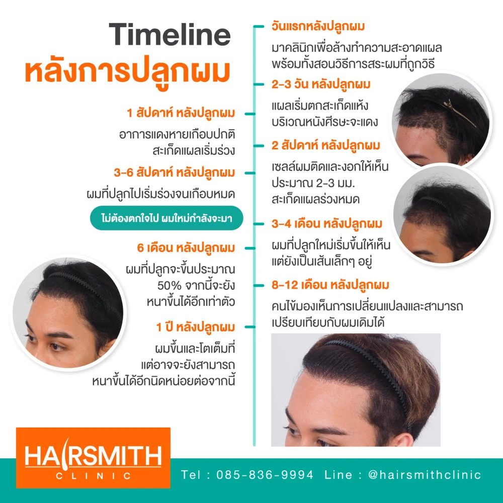 ปลูกผมกี่วันรากผมติด 01