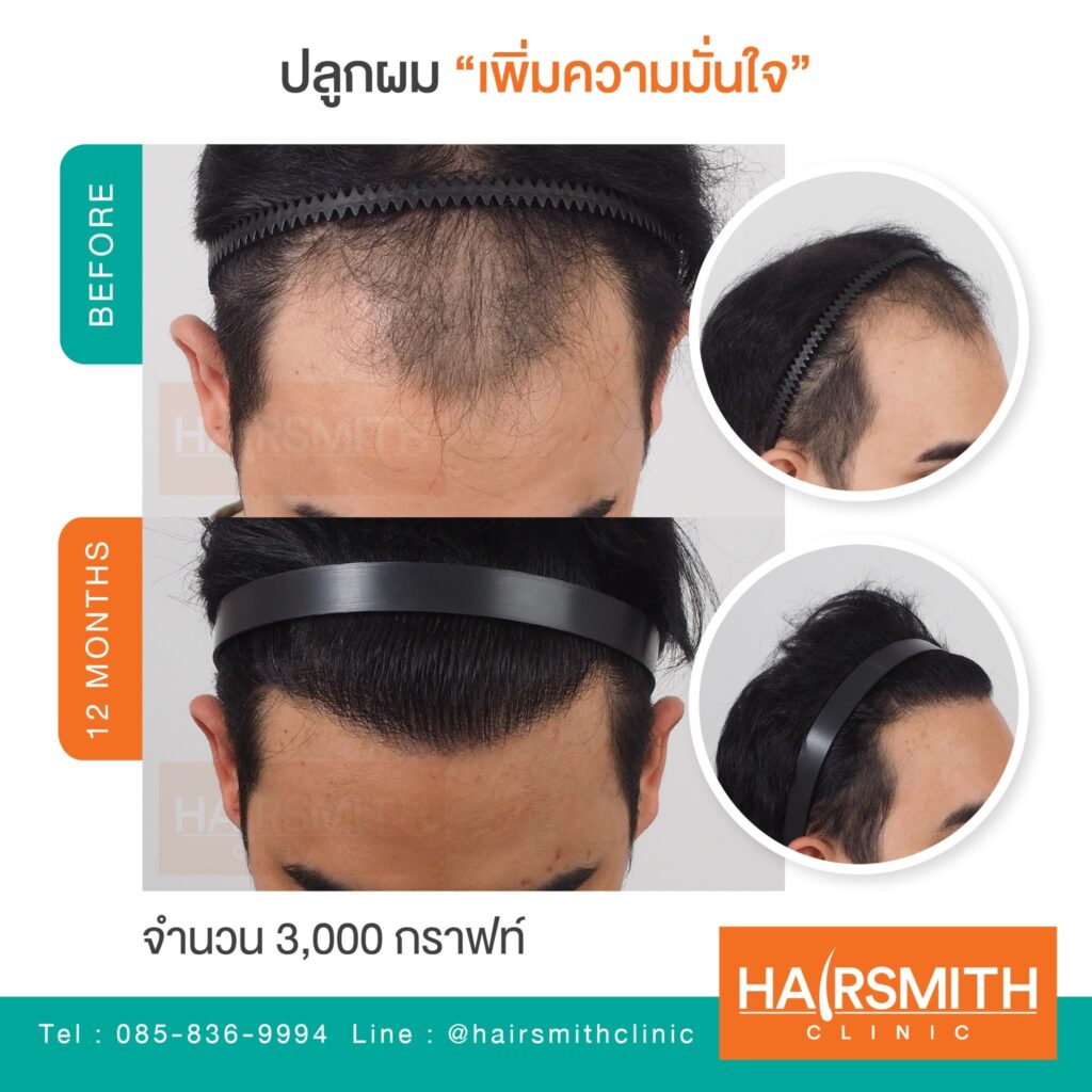 ราคาปลูกผม 2568