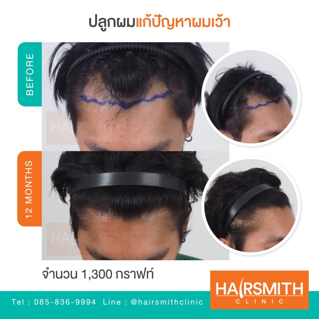 ปลูกผมราคา 2568