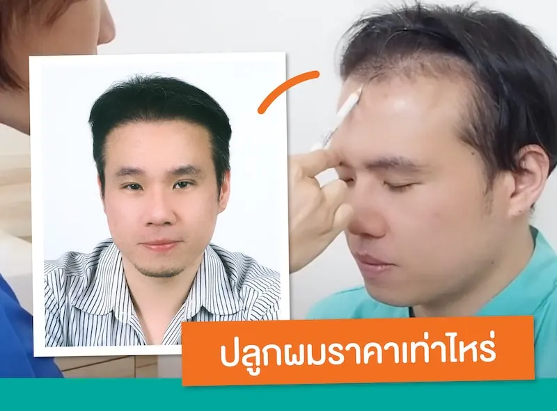ปลูกผมราคา
