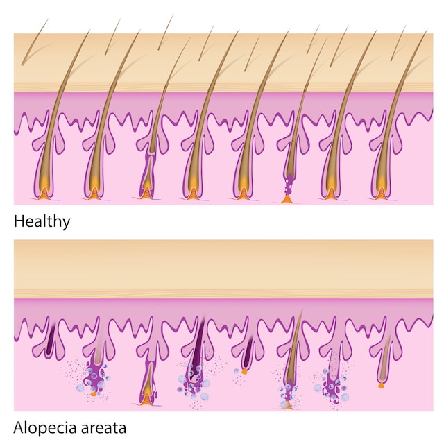 Normal,Hair,And,Alopecia,Areata