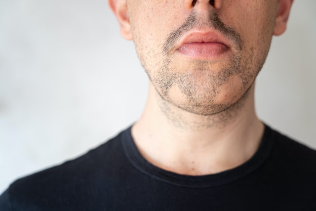 Close,Up,Of,Alopecia,Areata,On,A,Man's,Beard