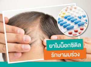ไมนอกซิดิล-MINOXIDIL-ช่วยเรื่องผมร่วงจริงหรือ_1