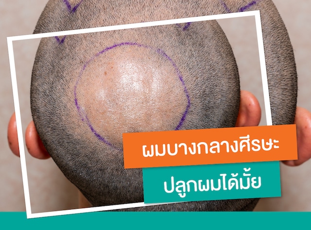 COULD THINNING HAIR ON THE CROWN BE TREATED WITH A HAIR TRANSPLANT_1