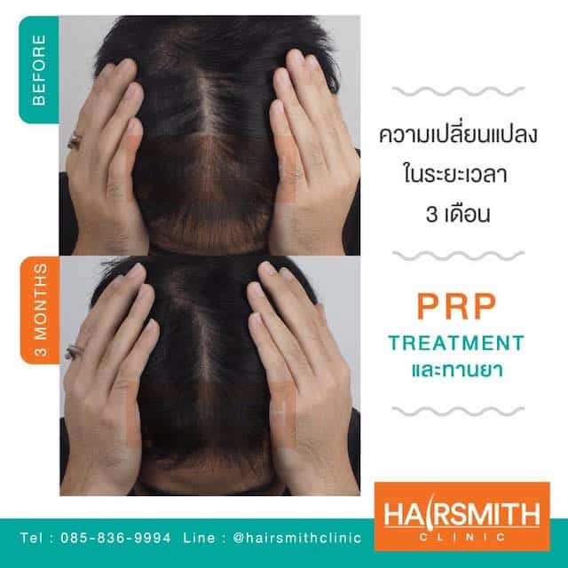 FAREWELL TO HAIR THINNING PROBLEM WITH PRP TREATMENT_3