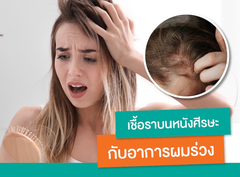 FUNGAL INFECTION OF THE SCALP AND HAIR LOSS PROBLEM_1