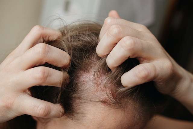 FUNGAL INFECTION OF THE SCALP AND HAIR LOSS PROBLEM_2