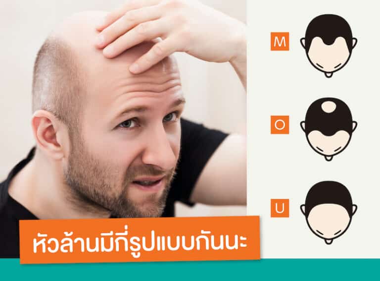 HOW-MANY-TYPES-OF-BALDNESS-ARE-THERE_1