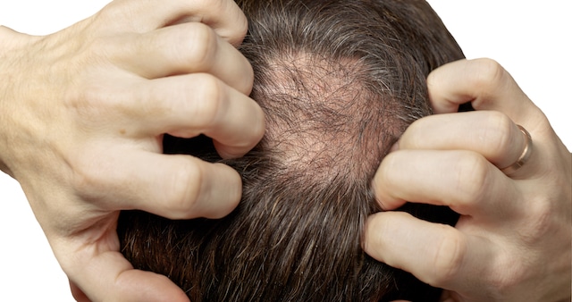 OVERCOMING HAIR THINNING PROBLEM FROM GENETICS_2