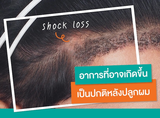 SHOCK LOSS NORMAL SYMPTOM THAT MAY OCCUR AFTER HAIR TRANSPLANTATION_1