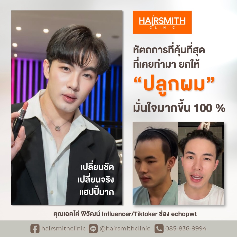 รีวิวปลูกผมเอคโค่ รีวิวปลูกผมเอคโค่