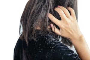 WHAT CAUSES DANDRUFF SOLUTION FOR THE DANDRUFF PROBLEM THAT BOTHERS YOU_2