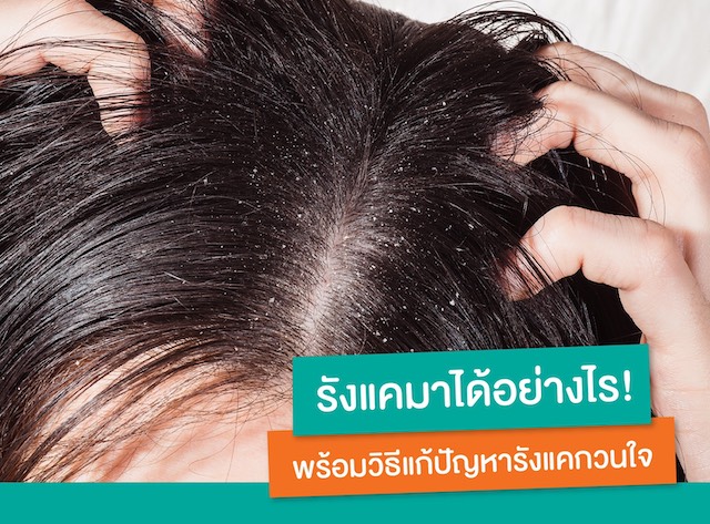 WHAT CAUSES DANDRUFF SOLUTION FOR THE DANDRUFF PROBLEM THAT BOTHERS YOU_4