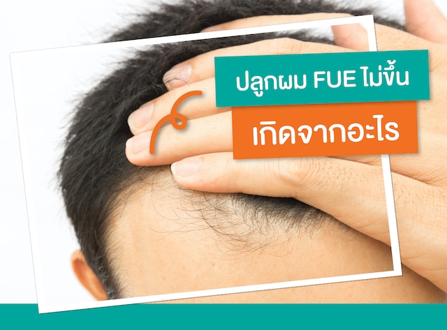 WHAT-CAUSES-FUE-HAIR-TRANSPLANT-TO-NOT-GROW_1.
