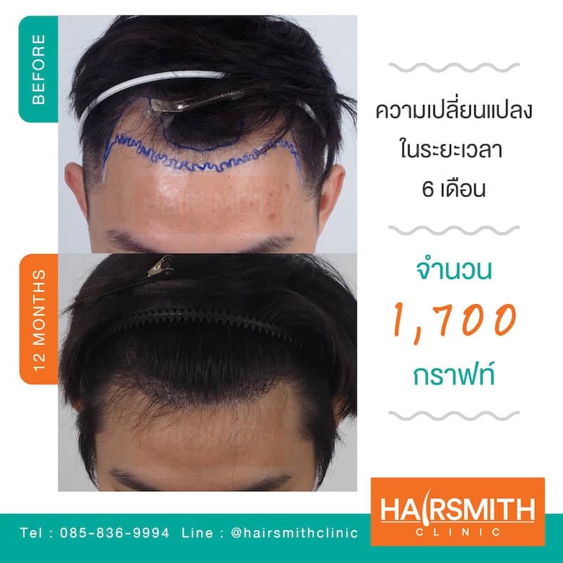 WHAT CAUSES FUE HAIR TRANSPLANT TO NOT GROW_5