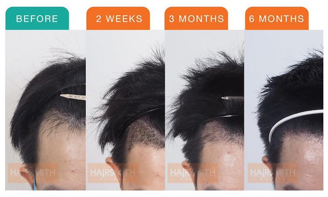 WHAT SHOULD YOU LOOK FOR WHEN FILTERING THROUGH HAIR TRANSPLANT PHOTO REVIEWS_2
