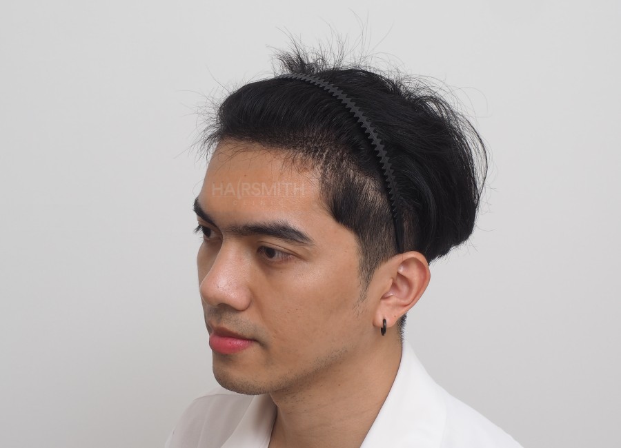 รีวิวปลูกผม คุณชิน03