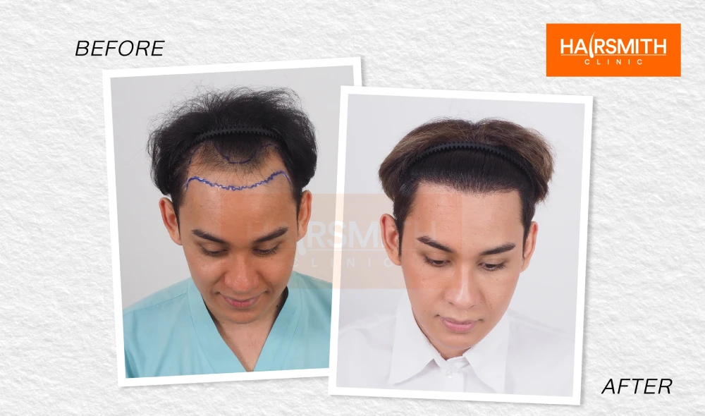 hair transplant result