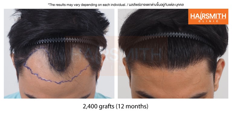 hair transplant result