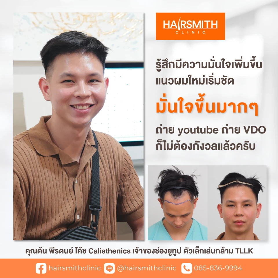 ปลูกผม ต้น พีรดนย์ โค้ช Calisthenics TLLK ปลูกผม ต้น พีรดนย์ โค้ช Calisthenics TLLK