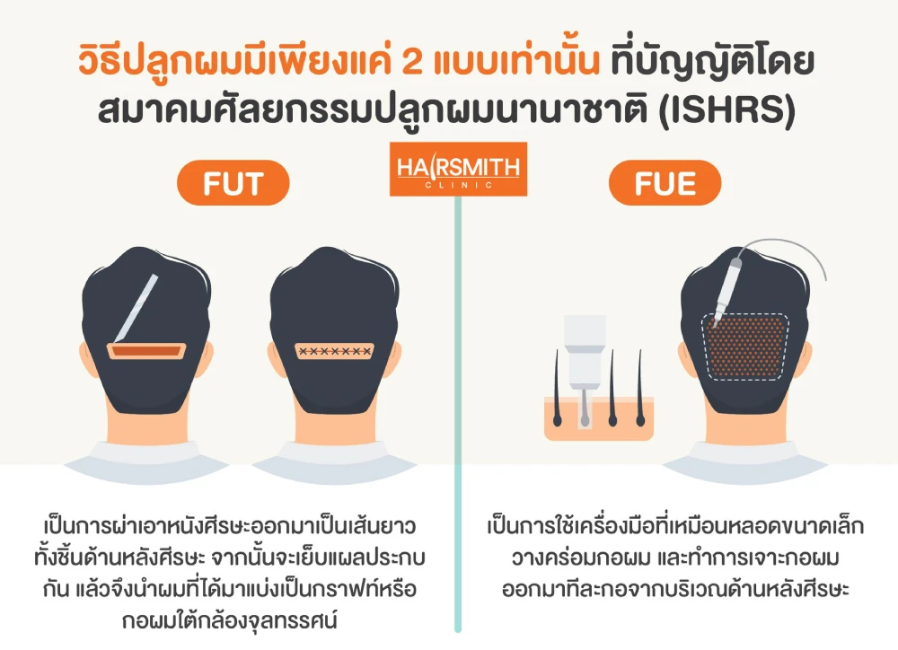 วิธีปลูกผม 2แบบ FUE และ FUT