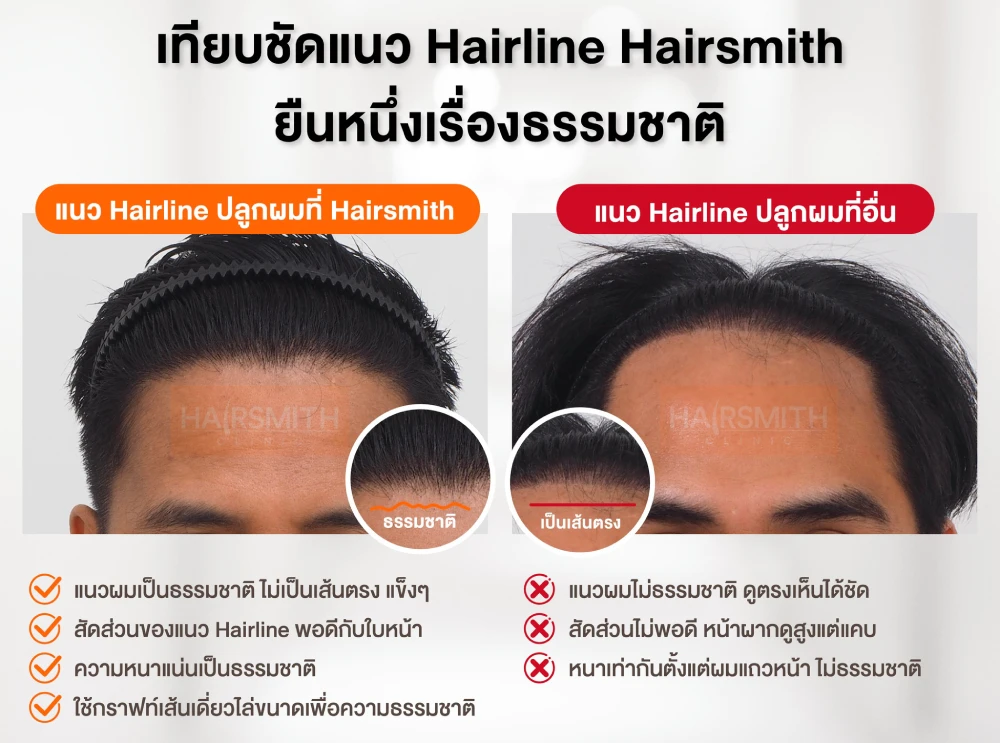 เปรียบเทียบปลูกผมที่ hairsmithclinic และคลินิกอื่น