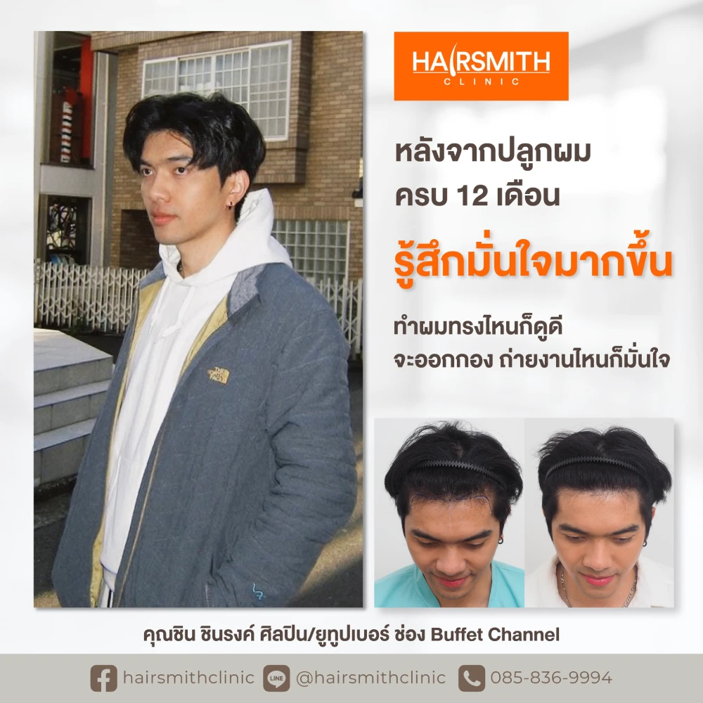 ปลูกผม ชิน ชินรงค์ Buffet channel ปลูกผม ชิน ชินรงค์ Buffet channel