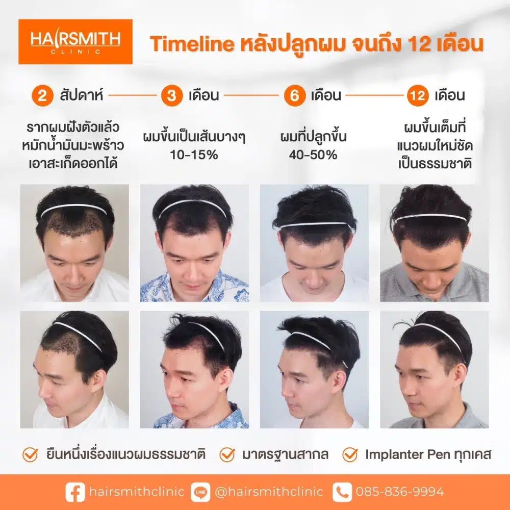 ปลูกผม เห็นผลเมื่อไหร่ 
Timelineหลัง ปลูกผม 12เดือน