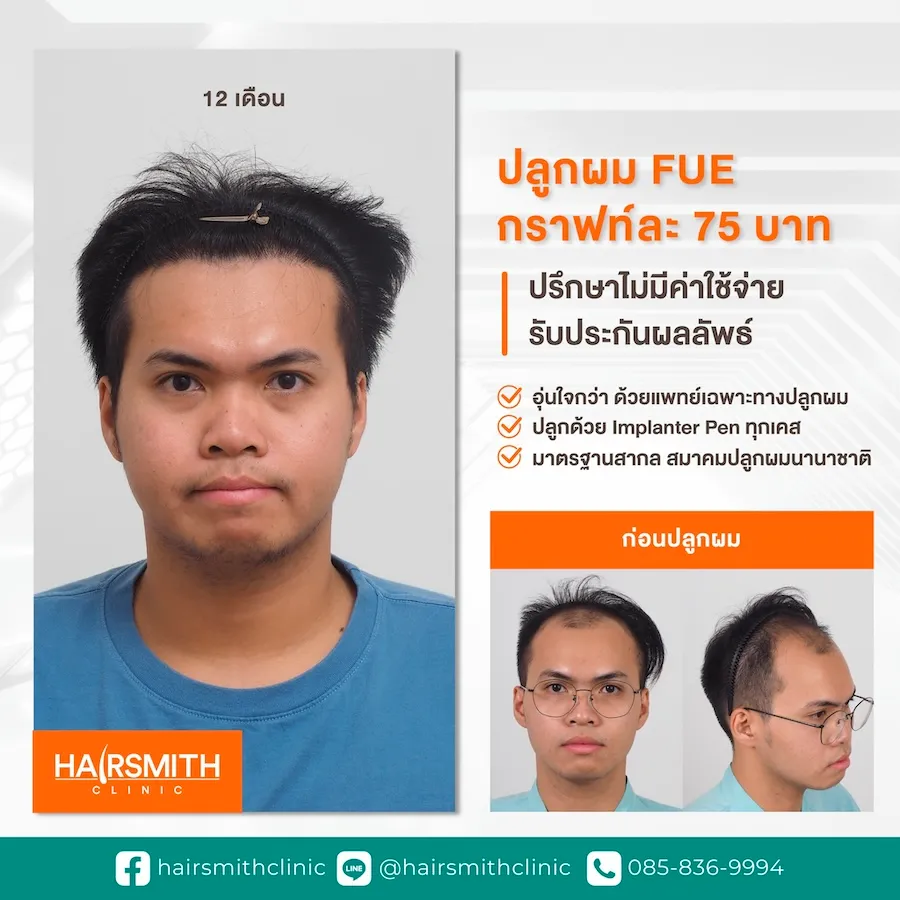 ปลูกผม DHI 