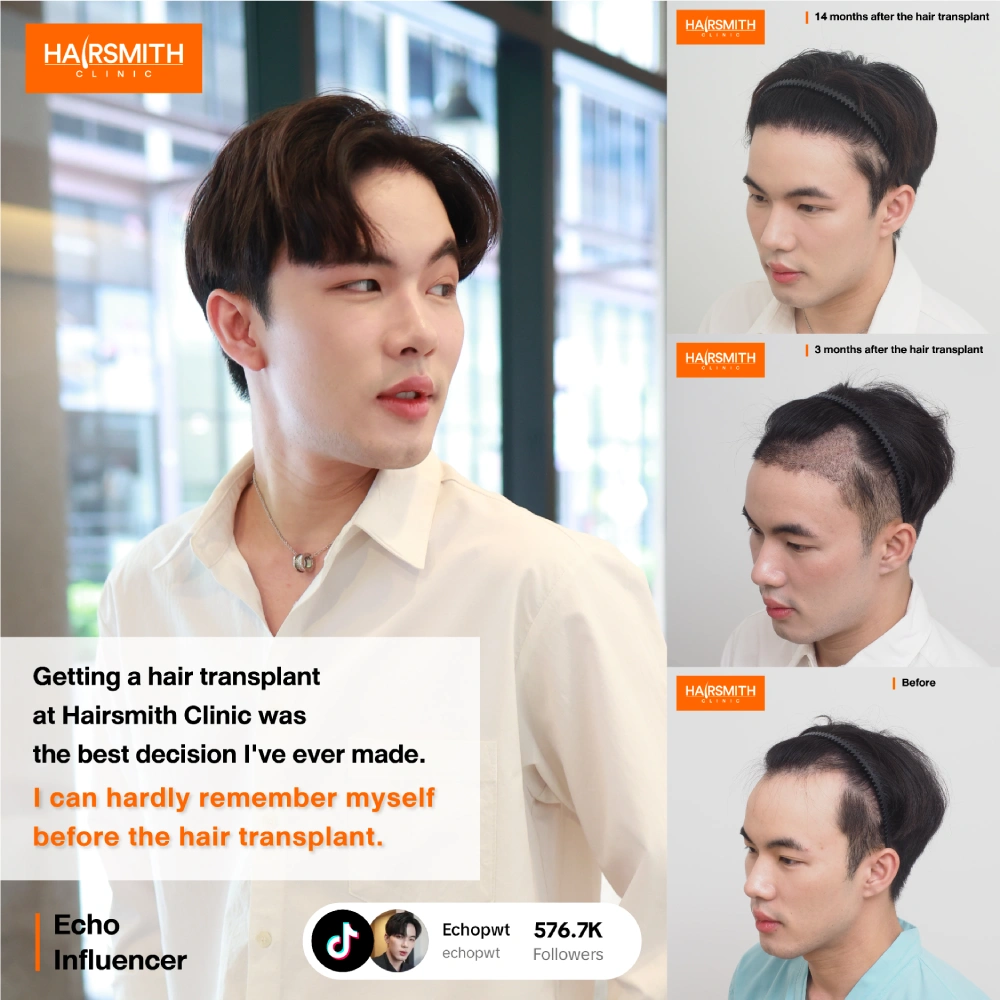 result of hair transplant