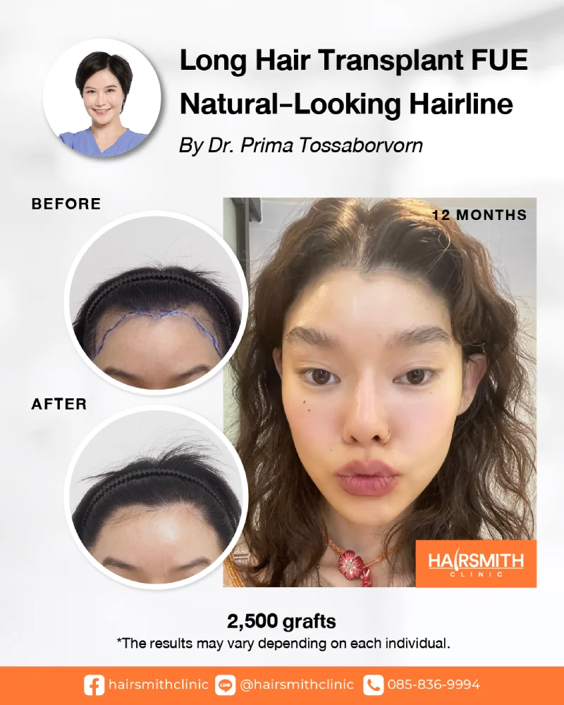 Long Hair FUE review Long Hair FUE review