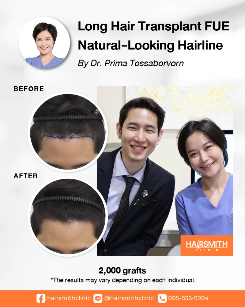 Long Hair FUE review Long Hair FUE review